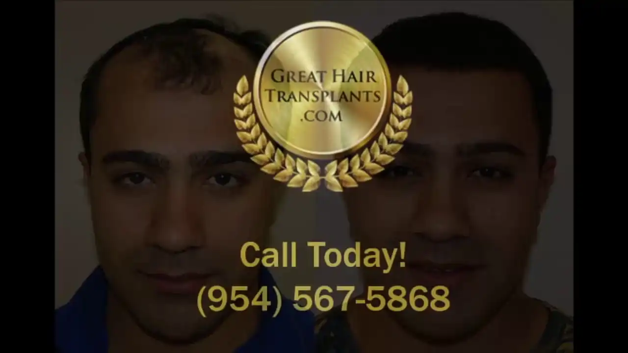
Dr. Brett Bolton Patient Amir MaxHarvest&trade; Plus Hair Transplant
