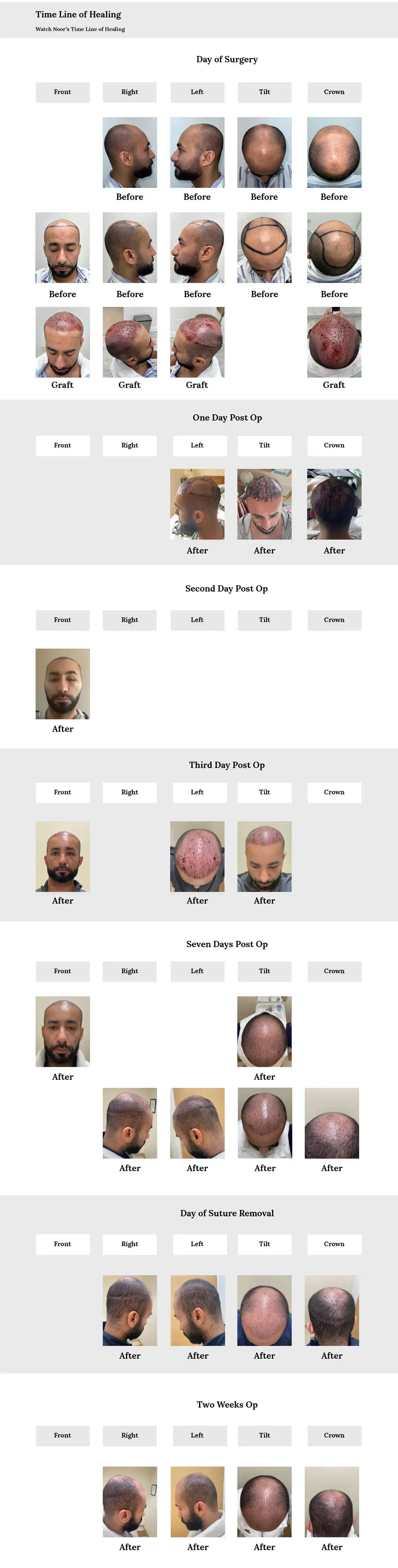 Hair Transplant Healing Timeline